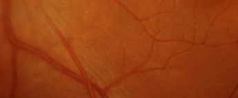 Retina CME